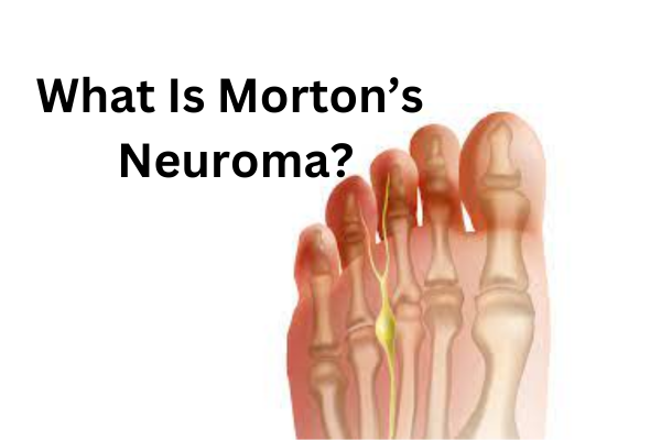 What Is Morton’s Neuroma?
